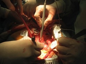 Transplant Errors