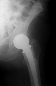 DePuy Pinnacle Hip Implant Failures 