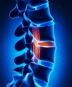 Spinal Cord Injury